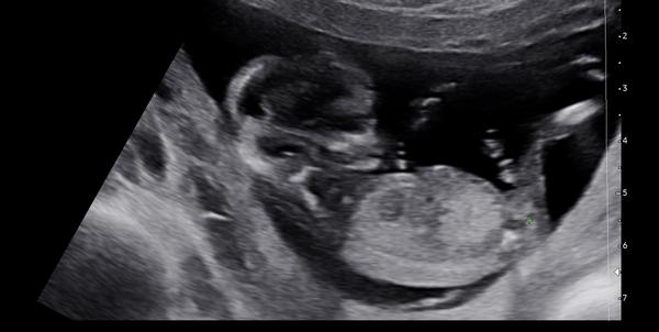 Dokáže lékař odhadnout pohlaví v 13. týdnu?