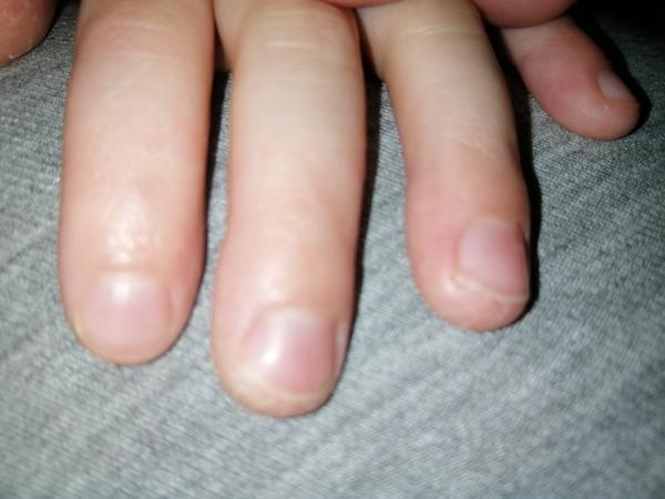 Pomoc pro dítě s popraskanými prsty před návštěvou lékaře