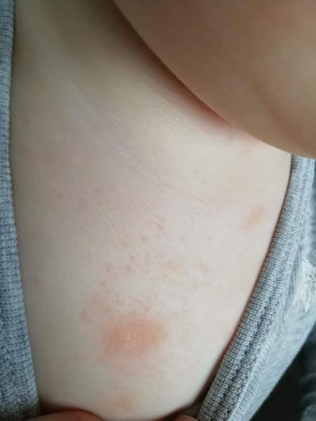 Vyrážka u 1,5 letého synka, alergie?