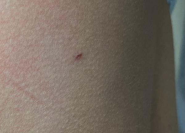 Mám se bát melanomu u drobného škrábance na zádech?