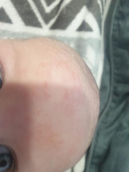 O jakou vyrážku se může jednat?