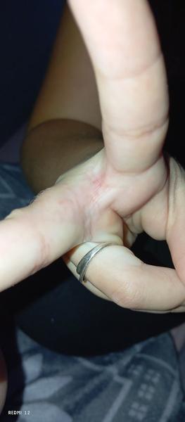 Co způsobuje svědivé pupínky mezi prsty u dcery?