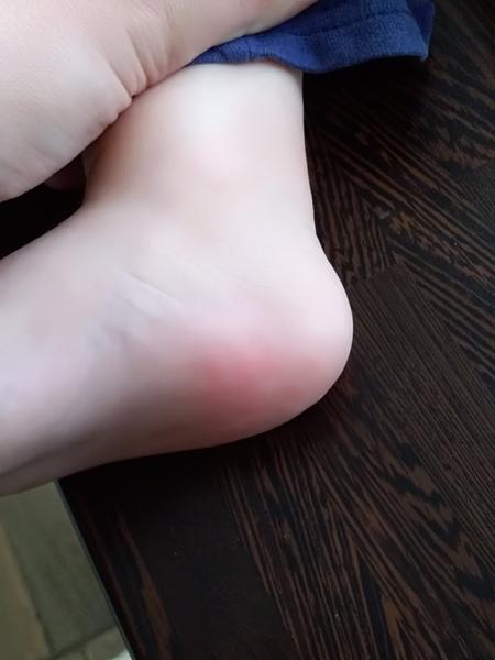 Vyrážka (ruce, nohy). Máte zkušenosti?