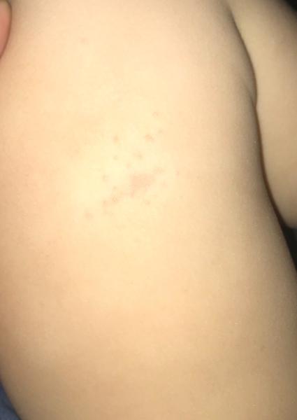 Vyrážka - pupínky s bílými puchýřky