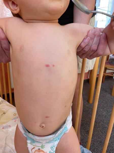 Červené flíčky na kůži u dětí. Co to způsobuje?