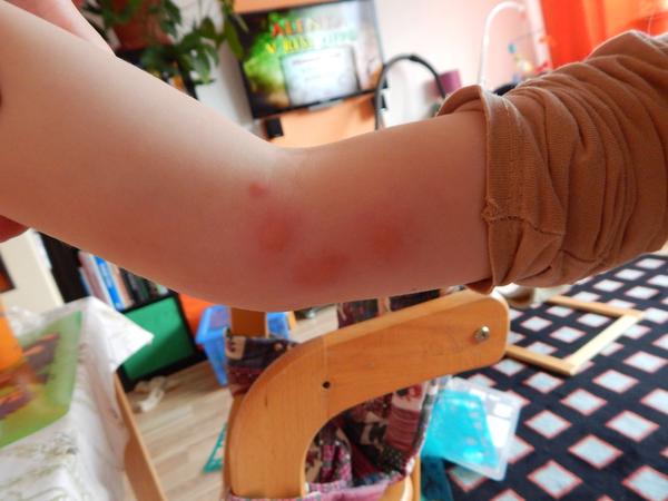 Štípanec nebo kopřivka?