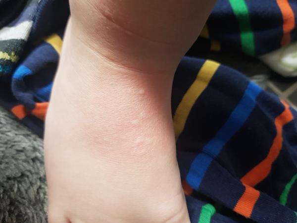 Co způsobuje pupínky u dětí a jak je léčit?