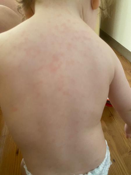 Co způsobuje vyrážku po dvoudenní horečce u dětí?