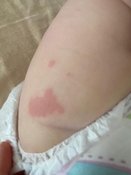 Vyrážka. Co myslíte?