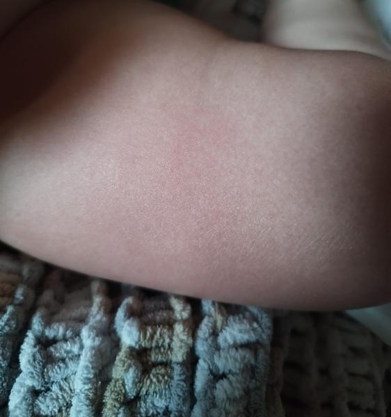 Podráždění batolecí pokožky vločkovacími tabletami. Máte zkušenost?