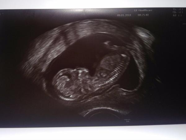 Holčička nebo chlapeček?