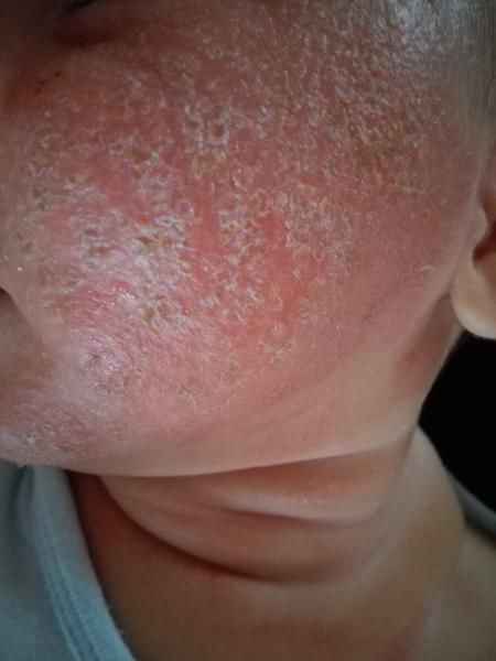 Přesný postup ošetření při ekzému 3měsíčního miminka