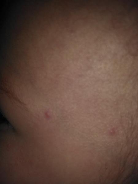 Ekzém nebo neštovice?