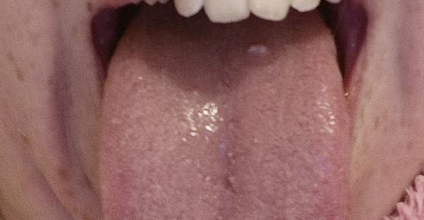 Co znamená bílá bradavice na jazyku?