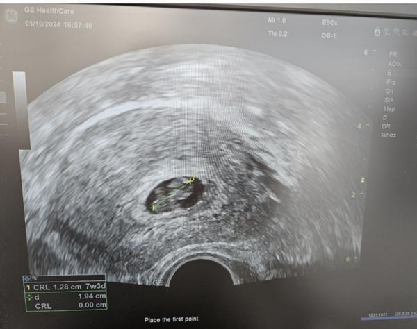 Málo místa v plodovém vejci. Co to může znamenat?