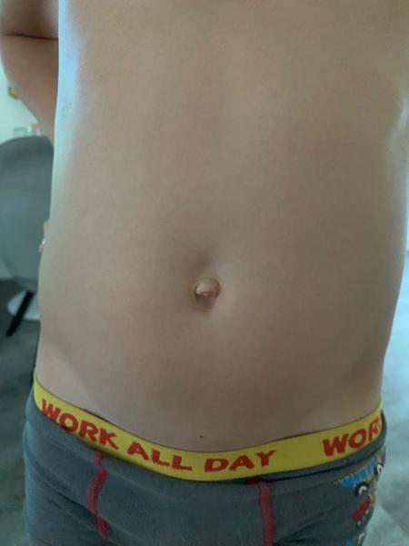 Kýla u dětí. Jak vypadá?