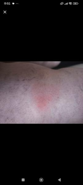 Štípanec. Borelióza nebo spíše nějaká reakce?