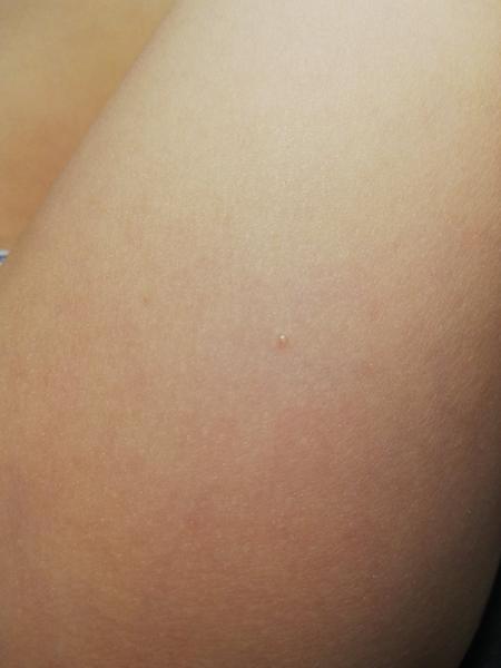 Obavy z neštovic před dovolenou: Jak poznat příznaky?