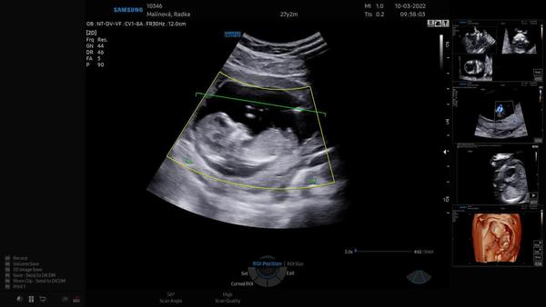 Pohlaví miminka. Nevíte, prosím, co čekáme?