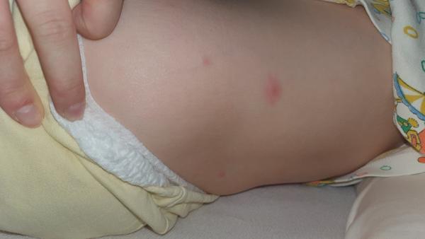 Vyrážka, infekce nebo neštovice. Poradíte, prosím, co by to mohlo být?