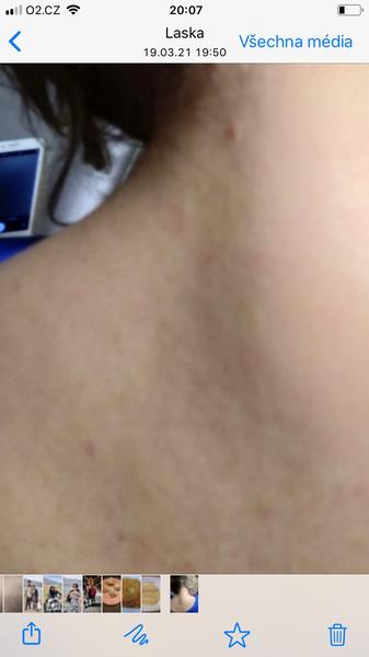 Fleky po celém těle. Co by to mohlo být?