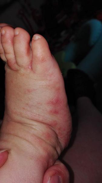 Alergie na mrkev u 11měsíční holčičky?