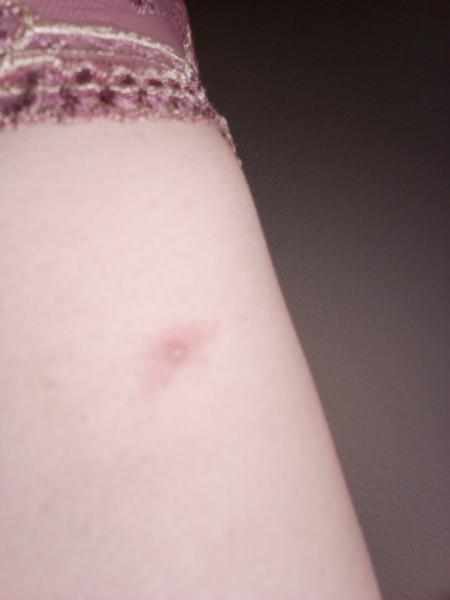 Asi mám neštovice ve 3. trimestru 😞