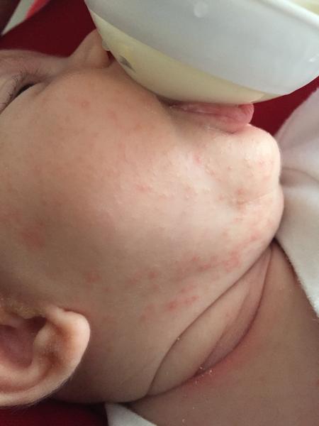 Vyrážka u miminka - co to může být?