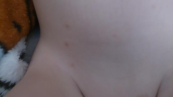 Mohou to být neštovice?