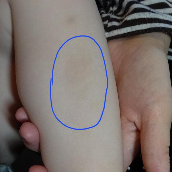 Neurofibromatóza. Je důvod k obavám? Jaká vyšetření jsou vhodná?