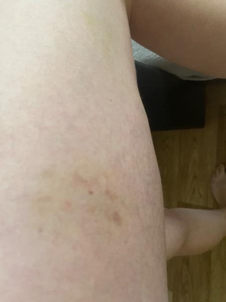 Co jsou červené skvrny na nohou?