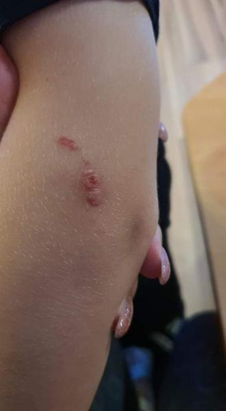 Horečky, vyrážka a bolest hlavy: Co to může být?