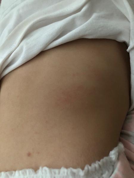 Ekzém, potničky, nebo zapařenina. Co myslíte?