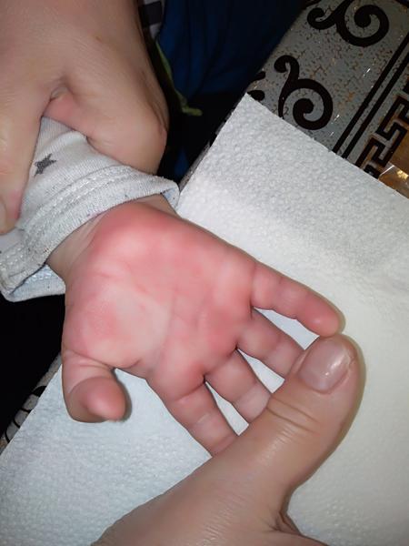 Vyrážka (ruce, nohy). Máte zkušenosti?