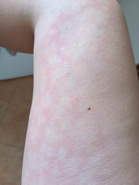 Příčiny vyrážky na noze. Co ji způsobuje?