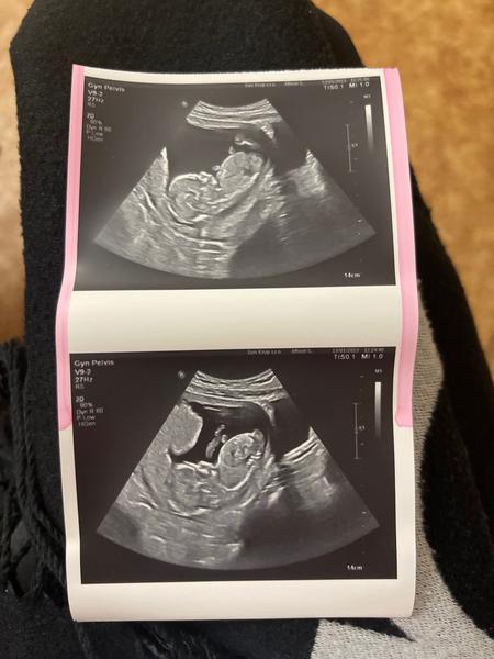 Jak poznat pohlaví dítěte z ultrazvuku ve 16. týdnu?