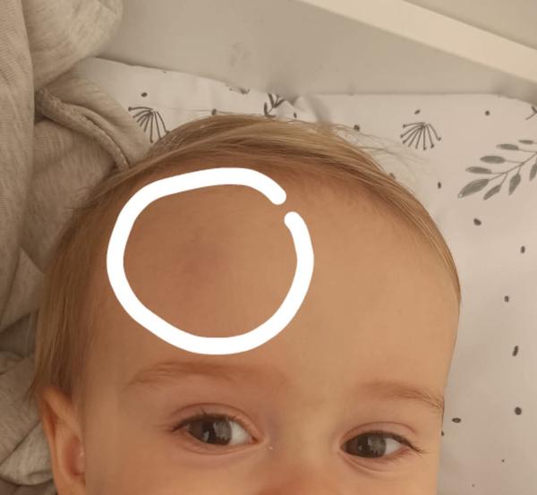 Co může způsobovat opakující se modřinu na čele dítěte?