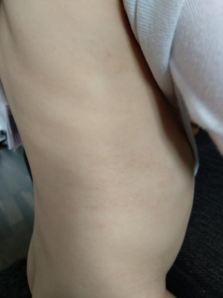 Je to ekzém? Dcera má fleky po celém těle