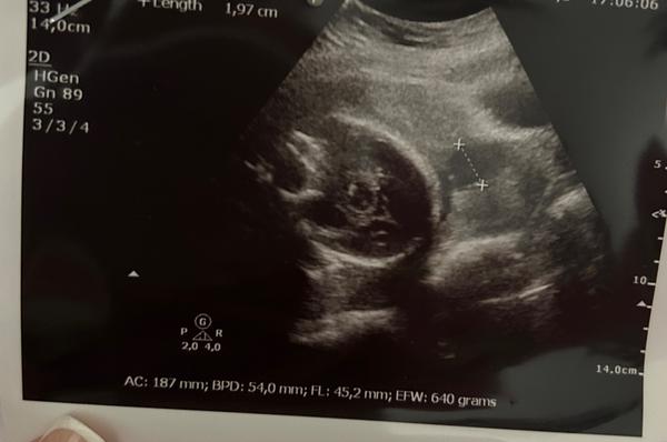 Jak se vypořádat s dehiscencí v jizvě po císaři?