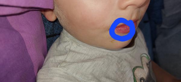 Jak poznat rozdíl mezi oparem a suchou kůží?