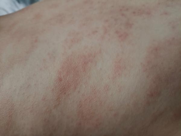 Vyrážka nebo ekzém u dětí. Jak zmírnit?