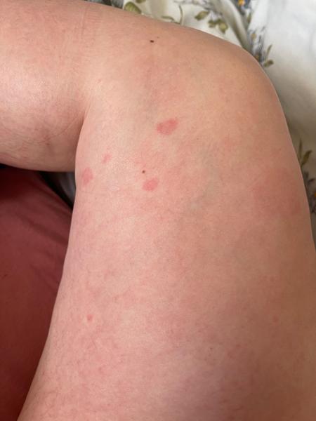 Alergie nebo kopřivka?