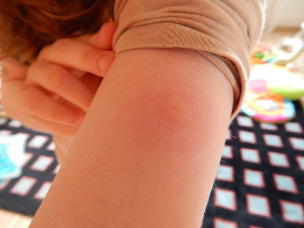 Štípanec nebo kopřivka?