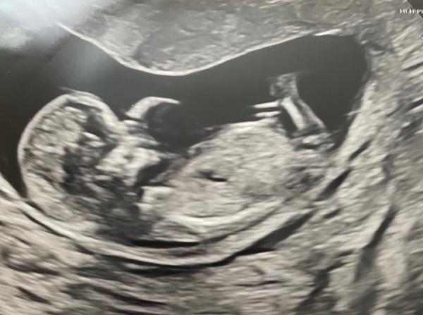 Pohlaví miminka. Máte tip?