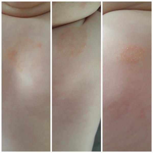 Ekzém 🤷‍♀️. Může to být?