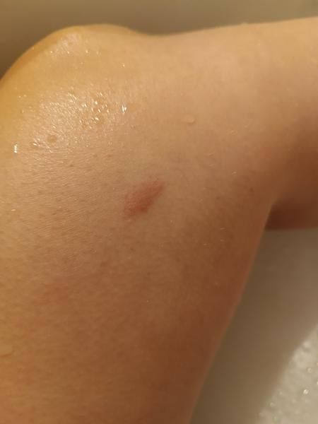 Jak řešit ohraničené vypouklé fleky na těle?