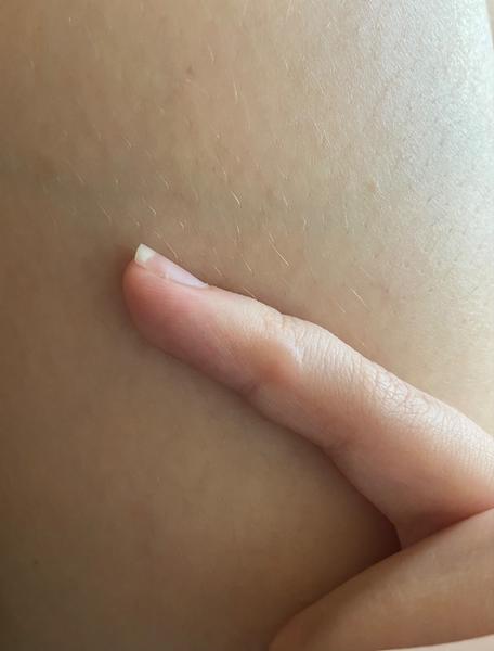 Jak řešit svědivé pupínky na prstech ruky?