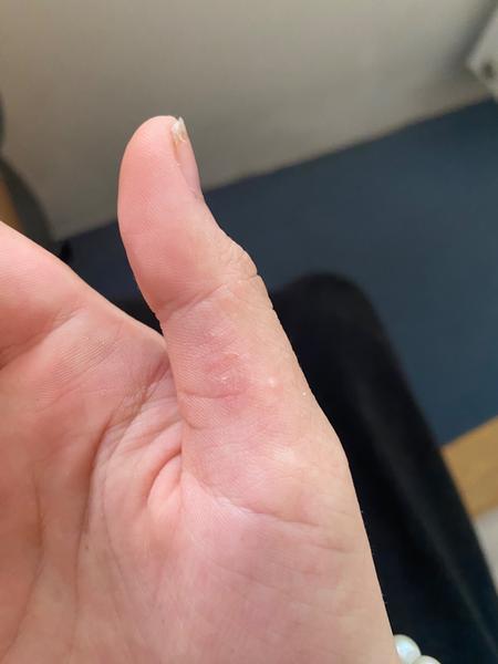 Je to svrab? Jak rozpoznat svrab a co s ním dělat?