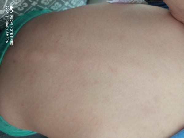 Mohlo by se jednat o ekzém?