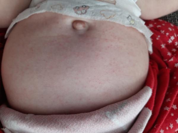Vyrážka na prsou, bříšku a čele u 4m. dítěte. Co by to mohlo být?